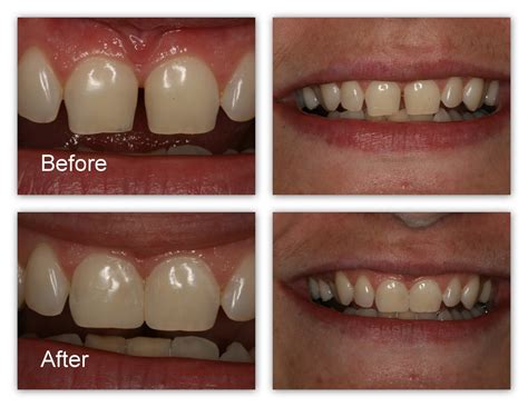 Tooth Colored Fillings Gallery - Dr. Jack M. Hosner, D.D.S.