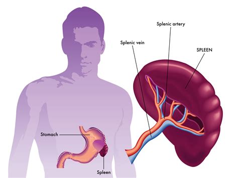 Splenomegaly – Ayurveda Concept, Symptoms, Causes, Remedies