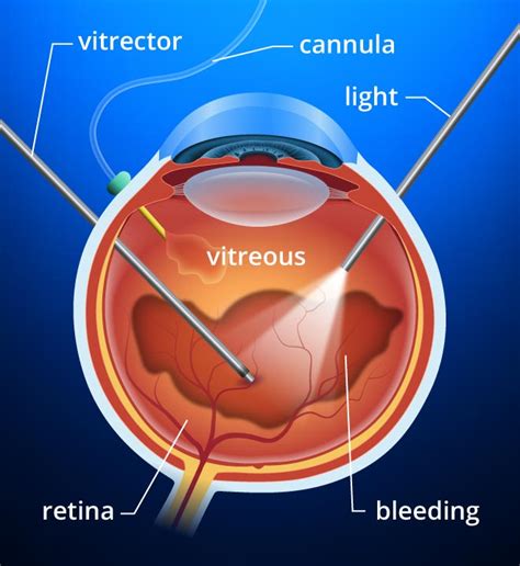 Vitrectomy - Fraser Eye Care Center