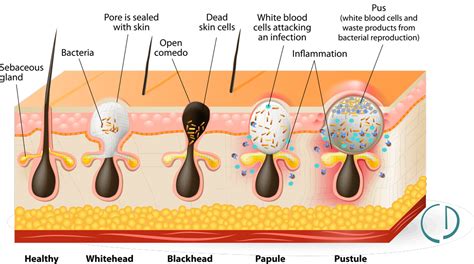 Acne - Colleyville Dermatology