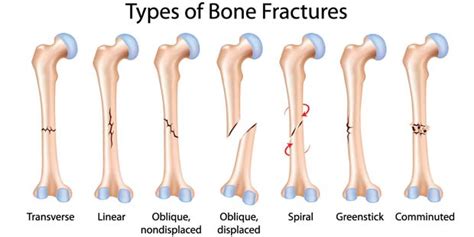 Bone fractures: Types, Symptoms, Prevention and Treatments ~ Way To Be ...