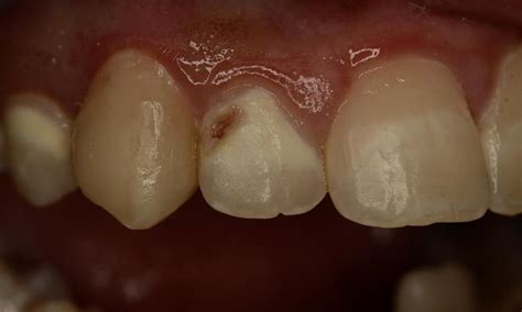 How Do Dentists Fill Cavities In Front Teeth - Teeth Poster