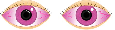 Pink Eye Facts - Eye Department Portland Eye Care & Eyewear