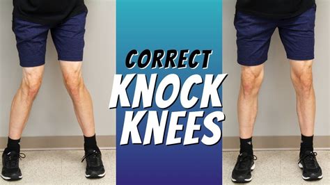 Top 5 Ways to Correct Knock Knees with Exercise Etc. | Knock knees ...