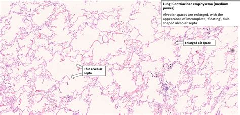 Lung – Emphysema – NUS Pathweb :: NUS Pathweb