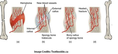 Bone Fracture - Types, Pathogenesis, Treatment, & Nursing Interventions