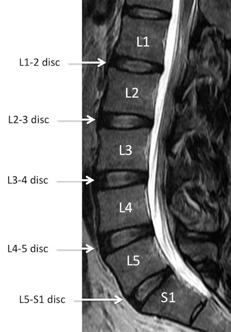 MRI Lumbar Spine Anatomy - Rocky Mountain Brain and Spine Institute