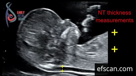 Nuchal translucency (NT) thickness measurement: for Early Fetal Scan ...