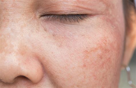 Prevent and Treat Hyperpigmentation - Dr. Stuart Miller