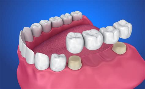 Different Types of Dental Crowns & Bridges - Magnolia Dental