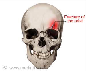 Causes, Symptoms and Signs of Orbital Fractures