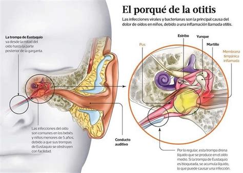 Dolor De Oido