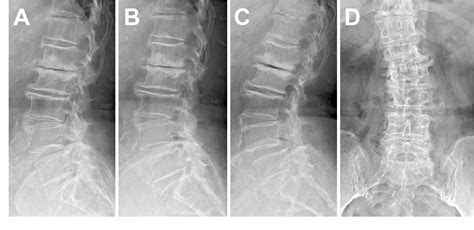 Low back pain due to middle cluneal nerve entrapment neuropathy ...