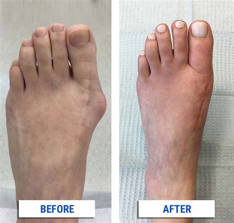 After Your Bunion Surgery - Alpine Foot Specialists