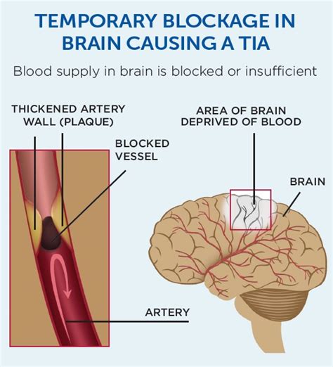 TIAs (warning strokes or mini-strokes) | Stroke Foundation NZ