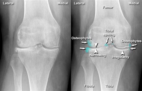 Osteoarthritis X Ray Hip