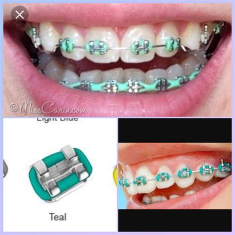 √ Braces Color Teal