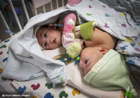 Texas twins conjoined at birth undergo separation surgery