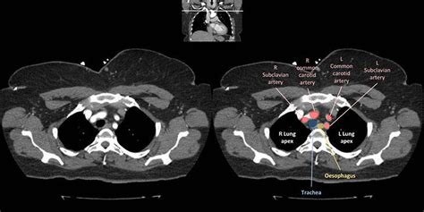 Chest anatomy - Radiology Cafe