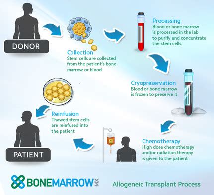 Risks of Stem Cell Transplants - Stem Cell Research