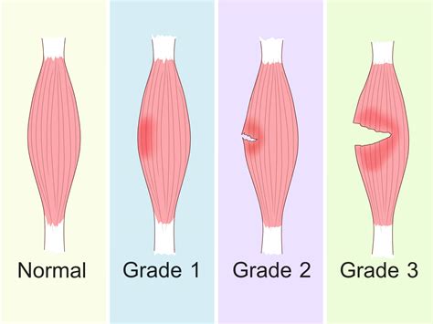 Quad Strain: Symptoms, Treatment, and Prevention