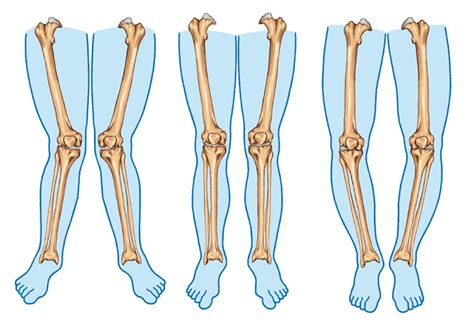 Explainer: what causes knock knees and do they have to be treated?