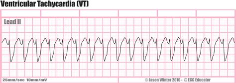 ECG Educator Blog : Ventricular Rhythms