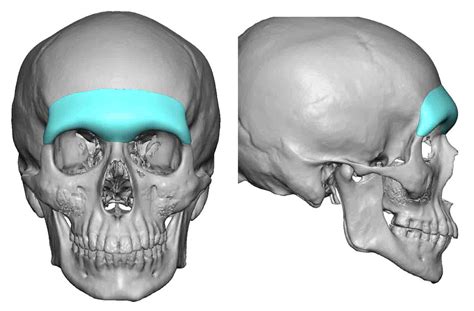 Custom Brow Bone Implant design frnt and side views Dr Barry Eppley ...