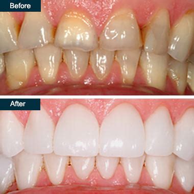 Porcelain Dental Crowns in Yonkers NY | Procedure & Cost