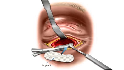 Orbital Floor Fracture Repair Surgery | Floor Roma