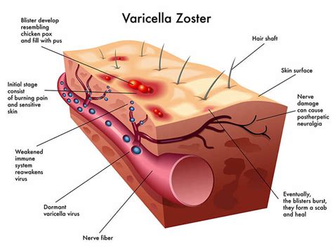 The Varicella-Zoster Virus - Viro Research