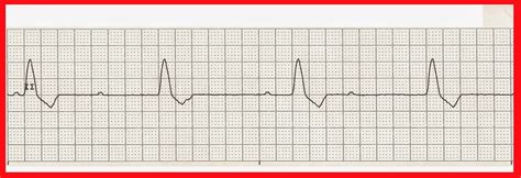 Practice EKG Rhythm Strips 216