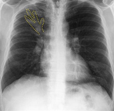 Aspergillus Chest X Ray