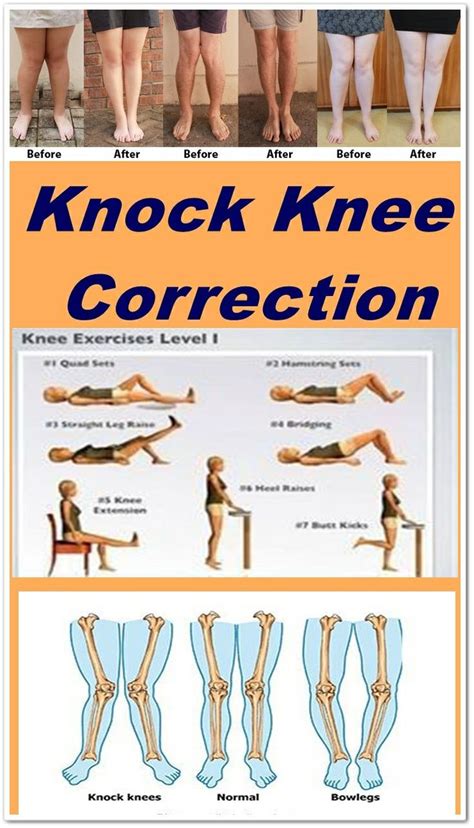 Knock knee correction | Knock knees, Knock knees correction, Knee