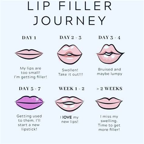 Lip Filler Journey & What To Expect! • LA Longevity