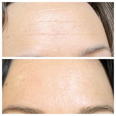 Wrinkle Removal Cream Reddit Retinol Clearance ...