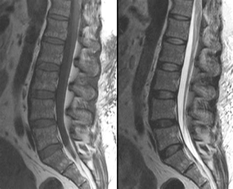 Normal Sagittal MRI