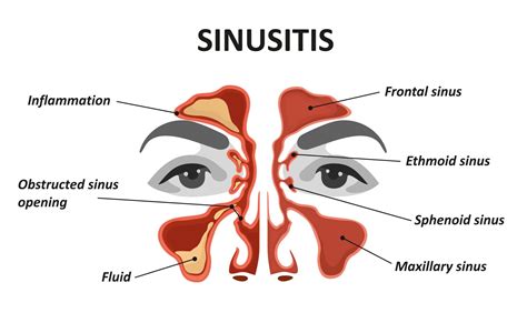 How Your Oral Health Can Affect Your Sinuses