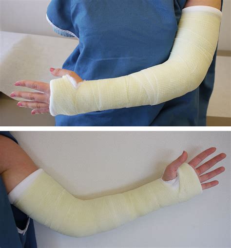 Care of Casts and Splints - OrthoInfo - AAOS