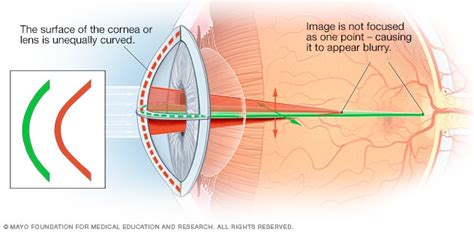 Astigmatism - Symptoms & causes - Mayo Clinic