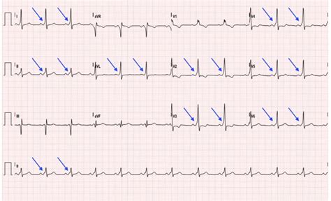 Wolff-Parkinson-White Syndrome: Electrocardiogram - JETem