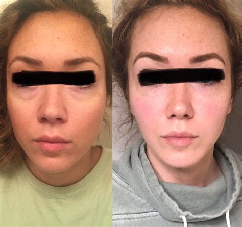 Dermal Fillers Before After Results Fairfax VA | Impressions MedSpa