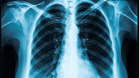 HOW DOES A CHEST X-RAY HELP DIAGNOSE BREATHING PROBLEMS? - Mayfair ...