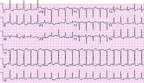 Wolff-Parkinson-White Alternans (WPW Alternans) ECG | LearntheHeart.com