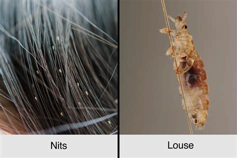 A Guide to Head Lice: Symptoms, Treatments, Prevention | The Healthy