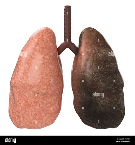 Healthy Lungs Vs. Unhealthy Lungs