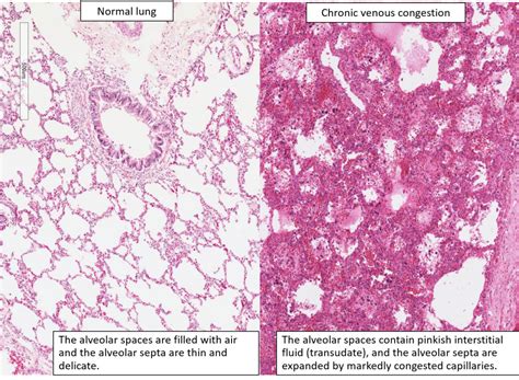 Chronic Venous Congestion Cvc Liver Cvc Lung Cvc Spleen Pathology ...