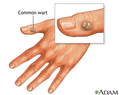 Warts: MedlinePlus Medical Encyclopedia