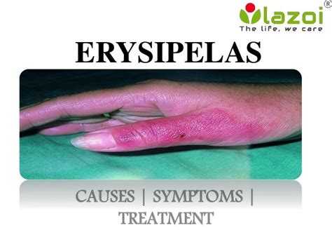 Erysipelas : causes, symptoms, diagnosis, prevention and treatments