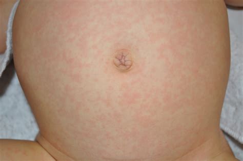 Baby Rash Pictures, Causes, Treatments - Mommyhood101